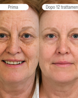 Sistema ad infusione Microneedling Anti-age