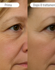 Sistema ad infusione Microneedling Anti-age