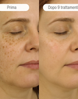 Sistema ad infusione Microneedling Anti-age