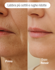 Sistema ad infusione Microneedling Anti-age