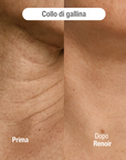 Sistema ad infusione Microneedling Anti-age